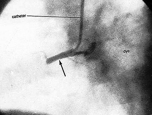 Procedura medica di cateterizzazione cardiaca