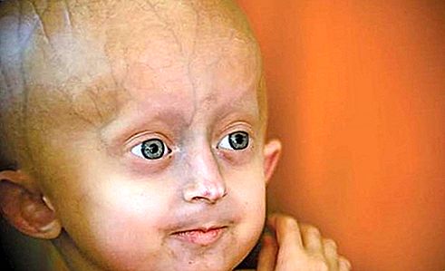 Patolohiya ng Progeria
