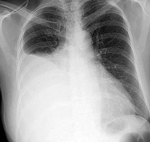 Keuhkopussin effuusiopatologia