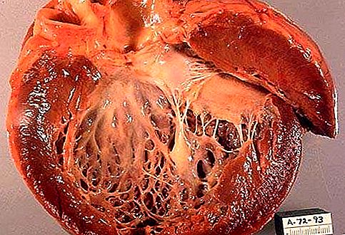 Patologia de cardiomiopatia
