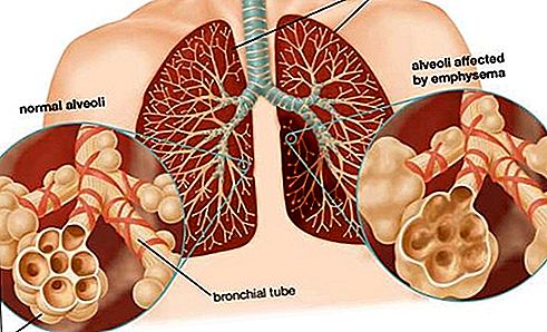 Patología obstructiva crónica de la enfermedad pulmonar.