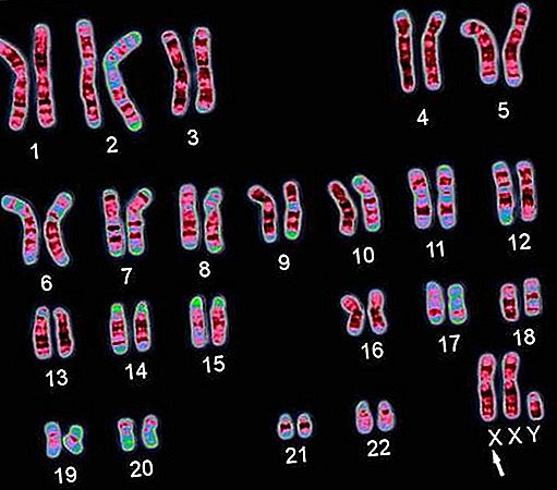 Syndrome chromosomique du syndrome de Klinefelter