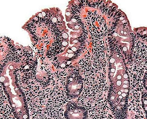Doença celíaca desordem digestiva auto-imune
