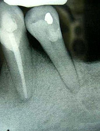 Malaltia de la geniva periodontitis