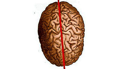 Sadalīto smadzeņu sindroma patoloģija